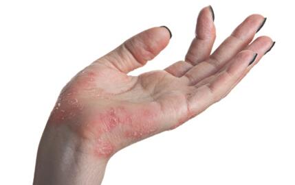 �����ļ�ҽԺ��������ʪ��