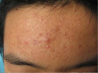 青春痘的护理误区